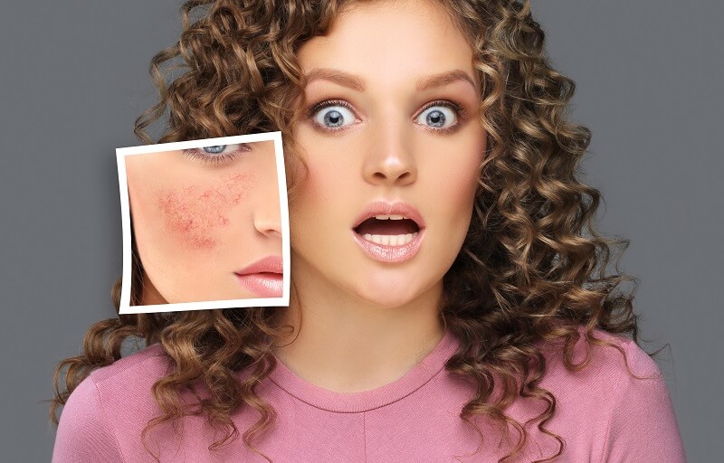 Microneedling for acne scars can help reduce their appearance.