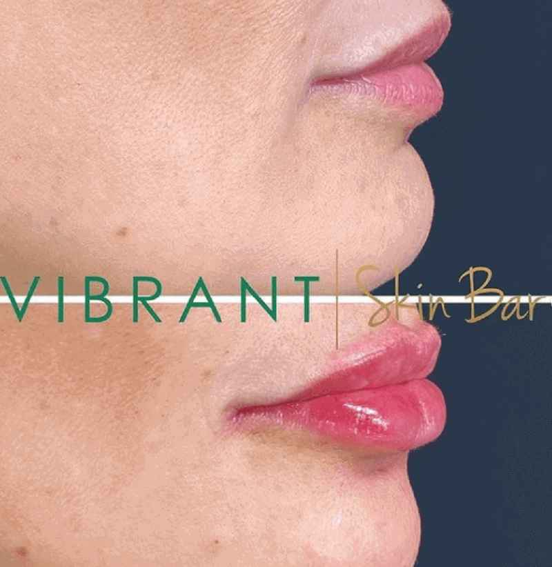 Before and after Juvederm