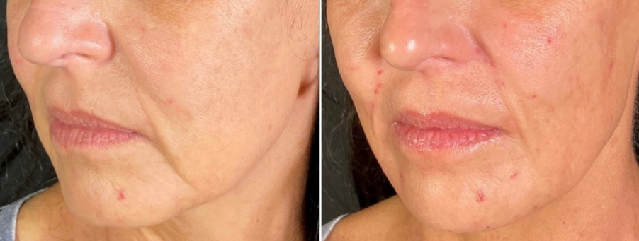 Before and after images of Botox smile lift procedure