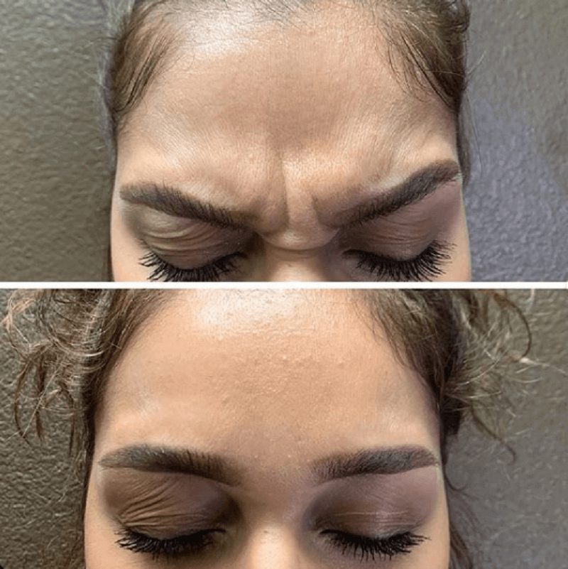 Before and after Botox for frown lines