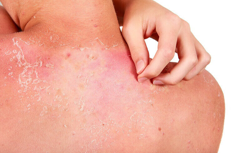 People with sunburn shouldn't peel their skin