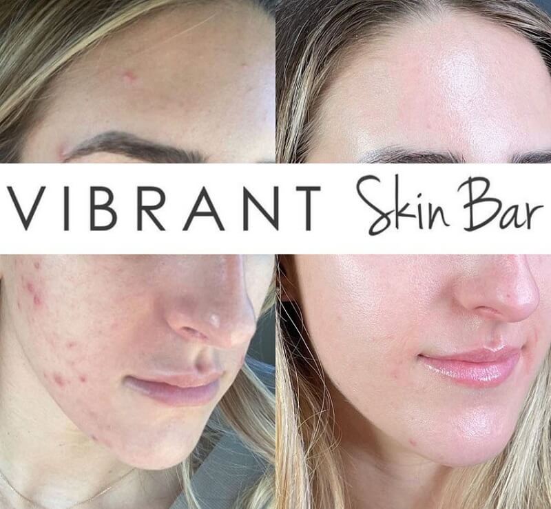 Microneedling before and after