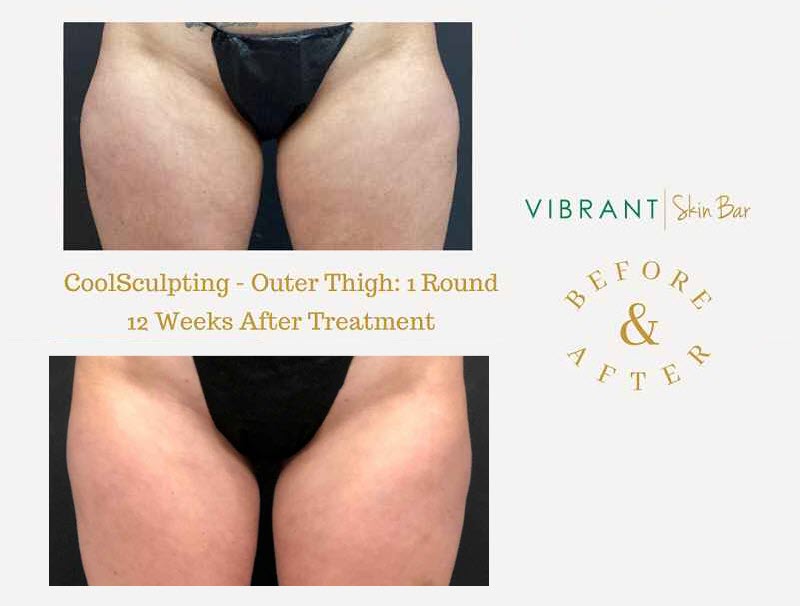 Outer thighs CoolSculpting before and after
