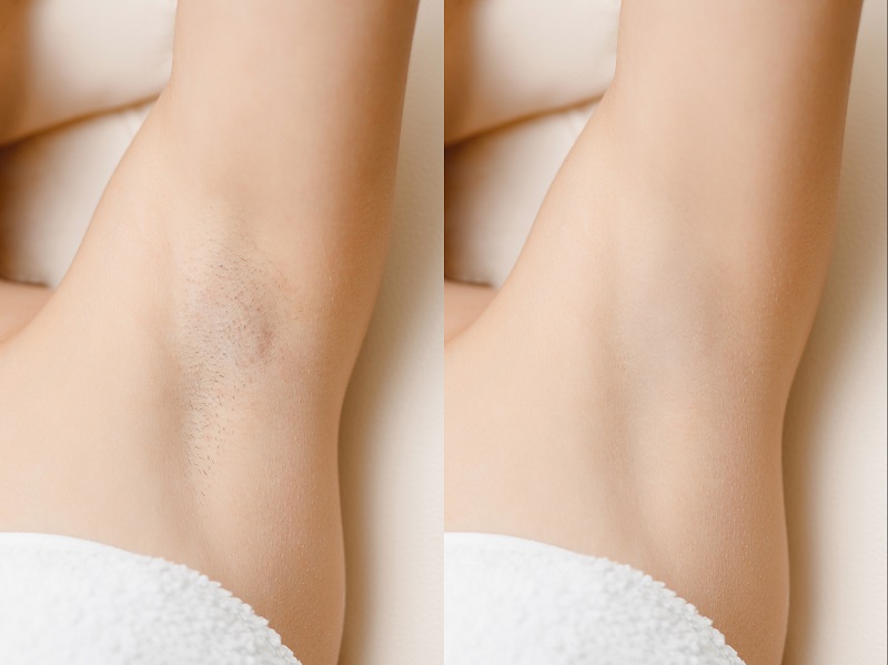 Laser hair removal before and after