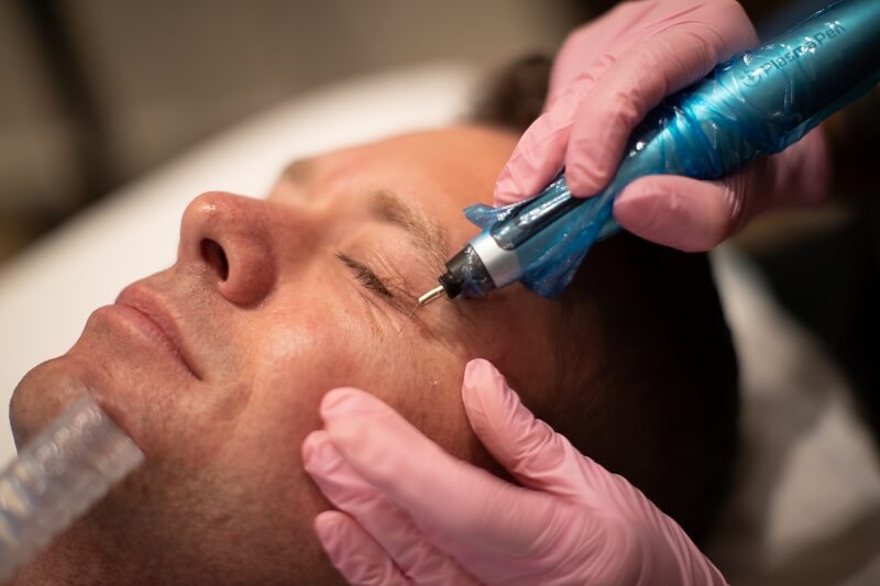 Plasma pen treatment