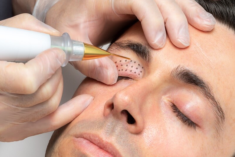 Plasma pen treats several facial and body areas