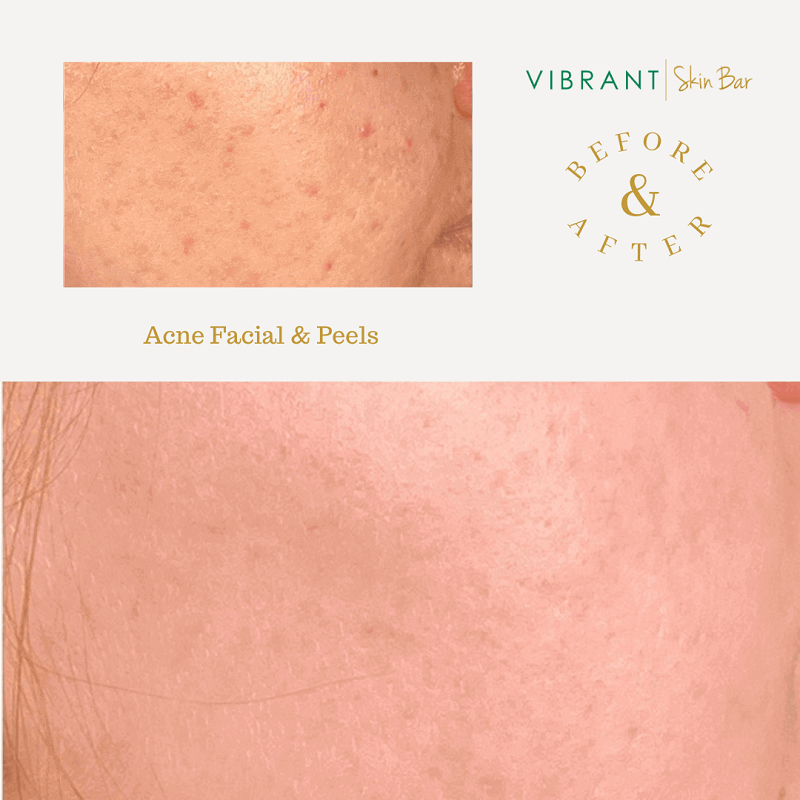 Before and after a chemical peel