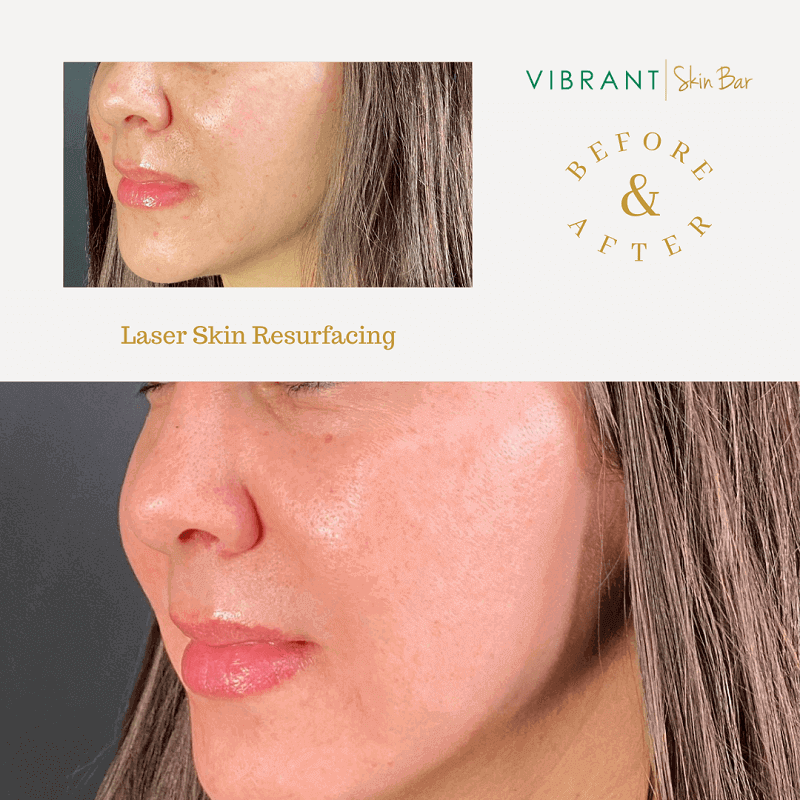 Before and after laser resurfacing