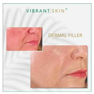 The results of versa filler vs. juvederm