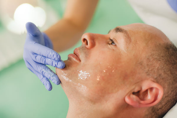 Acne treatment facial.