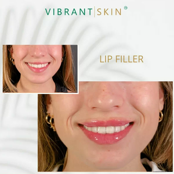 dermal fillers before and after