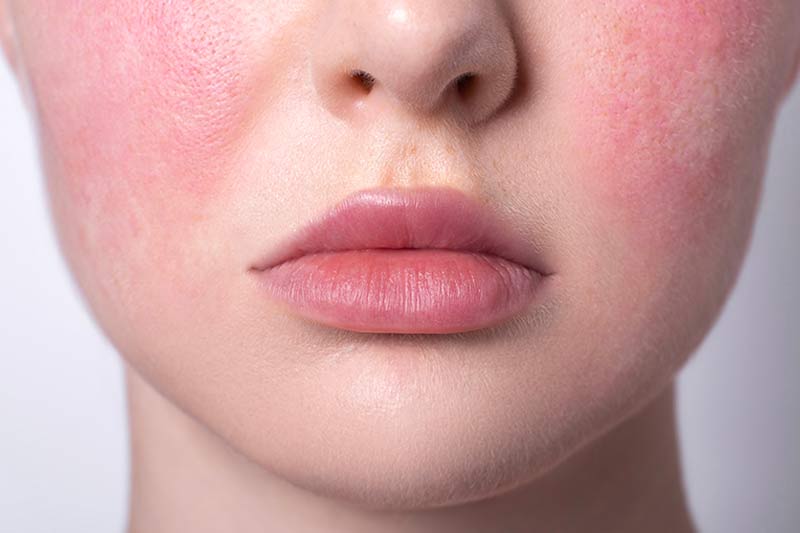 Holistic treatments for rosacea