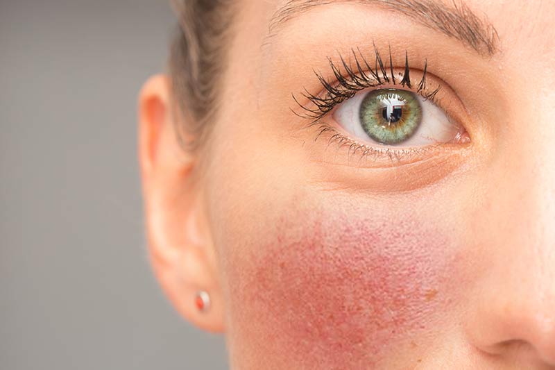 What is rosacea