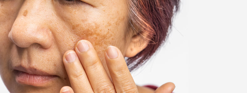 What is melasma?