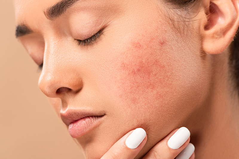 What is eczema?